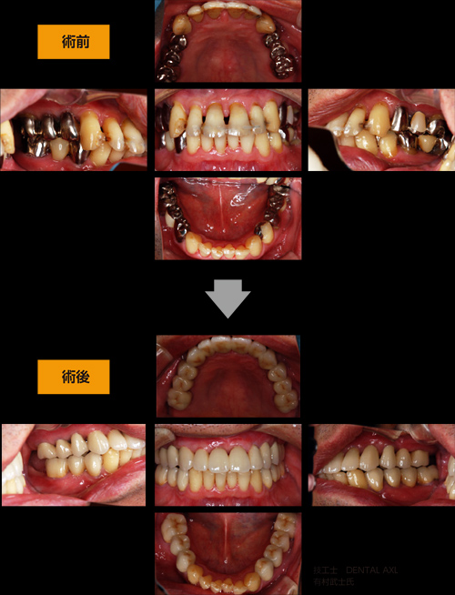 超可爱 歯牙移動による歯周組織再生療法 : 包括的歯科治療のなかでどう 